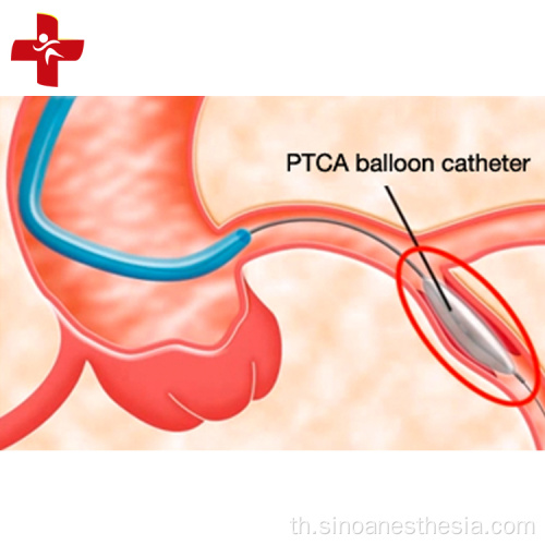 สายสวนบอลลูน PTCA ทางหลอดเลือด